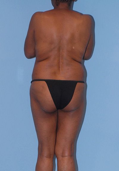 Brazilian Butt Lift Before & After