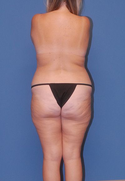 Brazilian Butt Lift Before & After