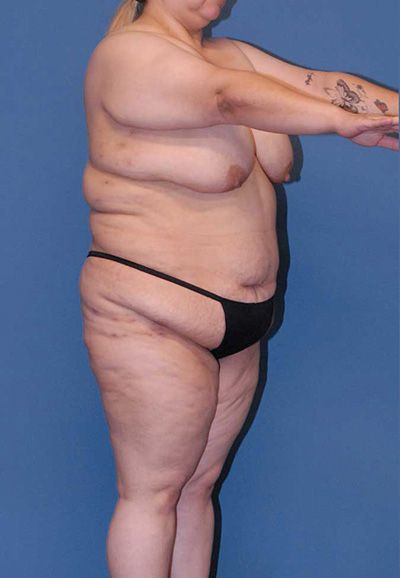 Torsoplasty Before & After