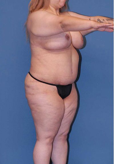 Torsoplasty Before & After