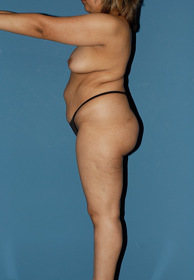 Torsoplasty Before & After