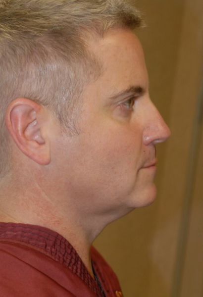 Tz Plasty Before & After