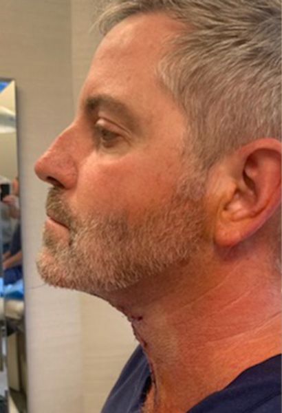 Tz Plasty Before & After