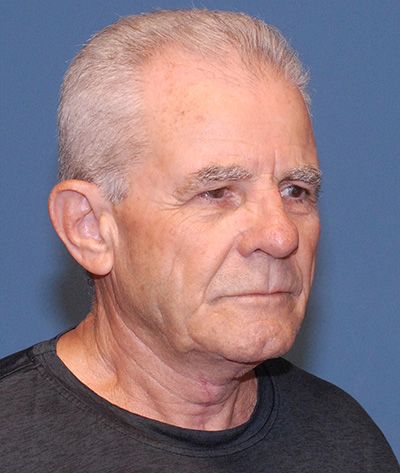 Tz Plasty Before & After