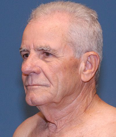 Tz Plasty Before & After