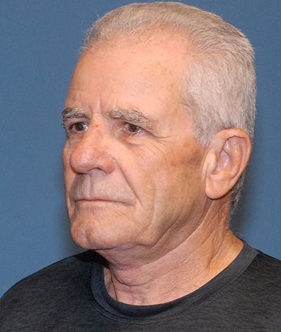 Tz Plasty Before & After