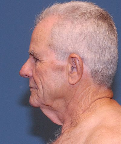 Tz Plasty Before & After