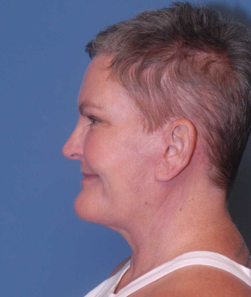 Face Resurfacing Before & After