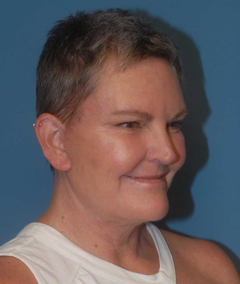 Face Resurfacing Before & After