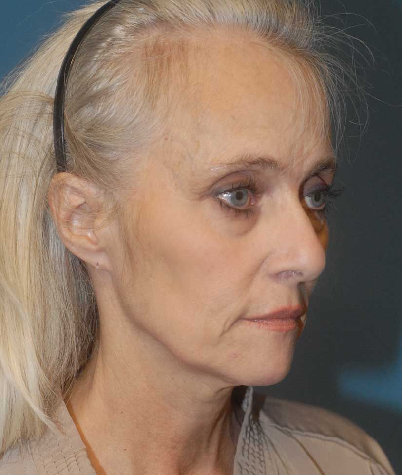 Face Resurfacing Before & After