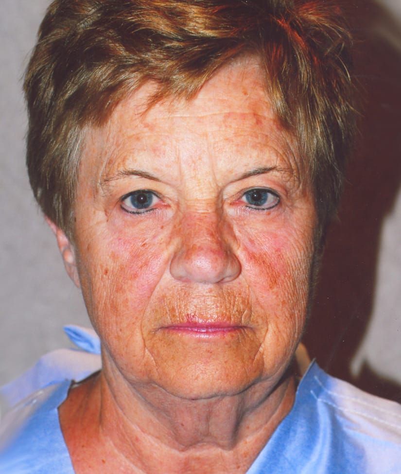 Face Resurfacing Before & After