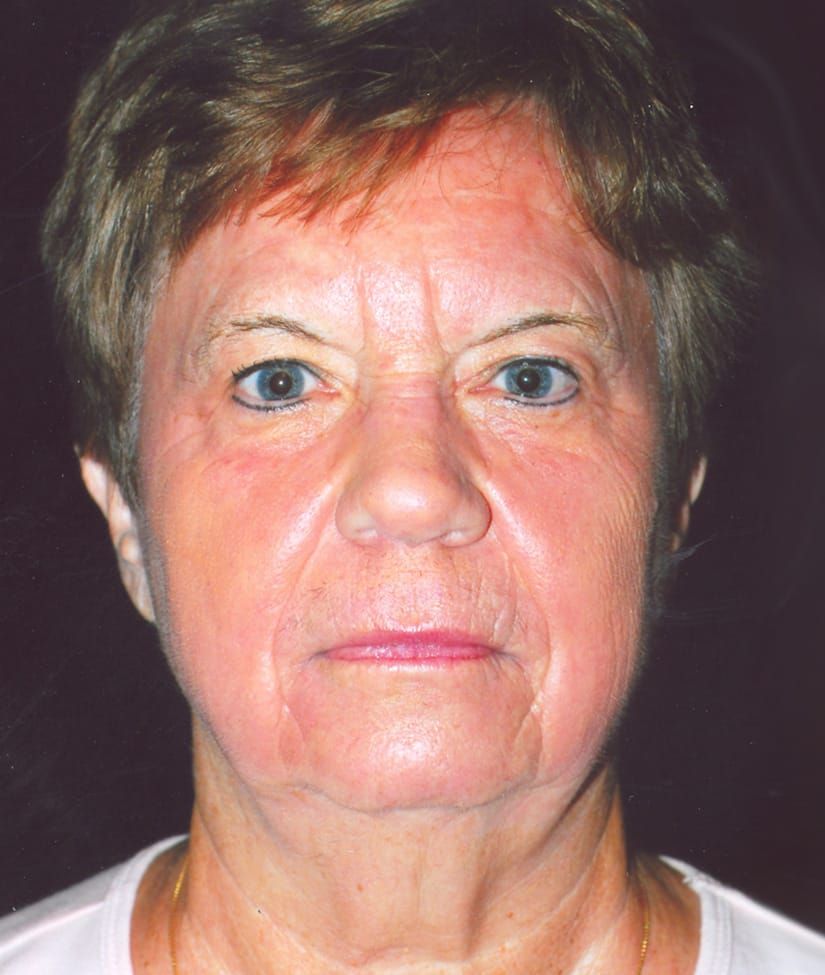 Face Resurfacing Before & After