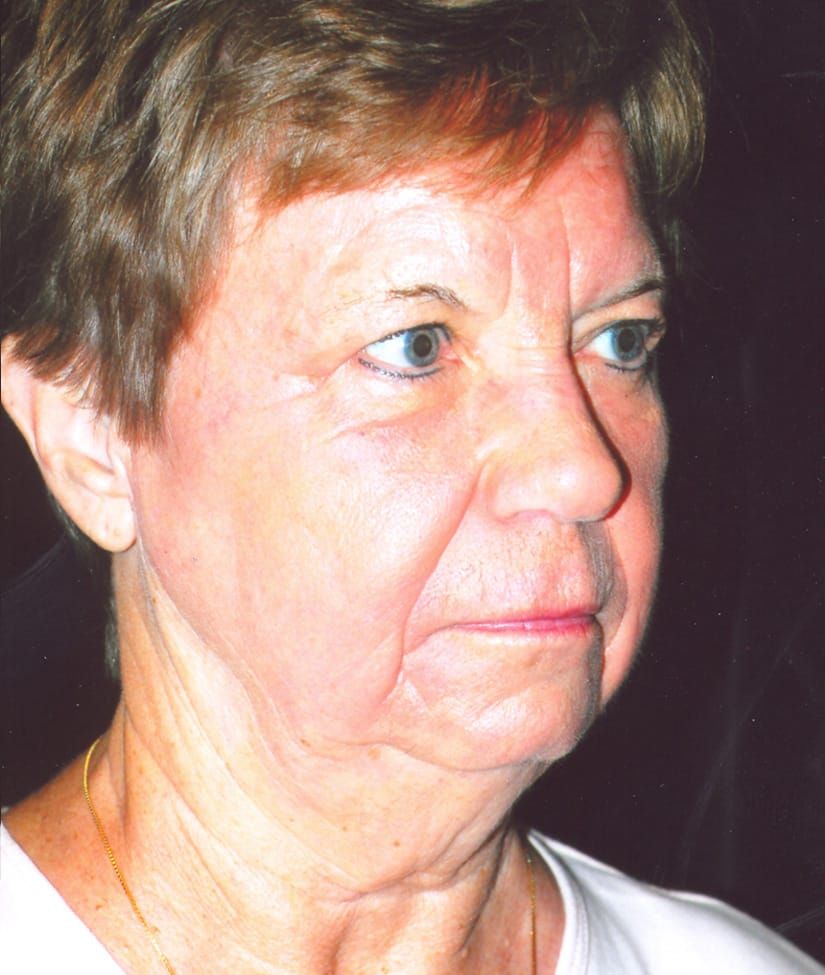 Face Resurfacing Before & After