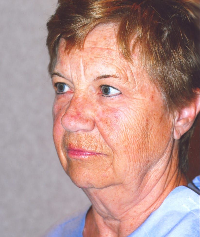 Face Resurfacing Before & After