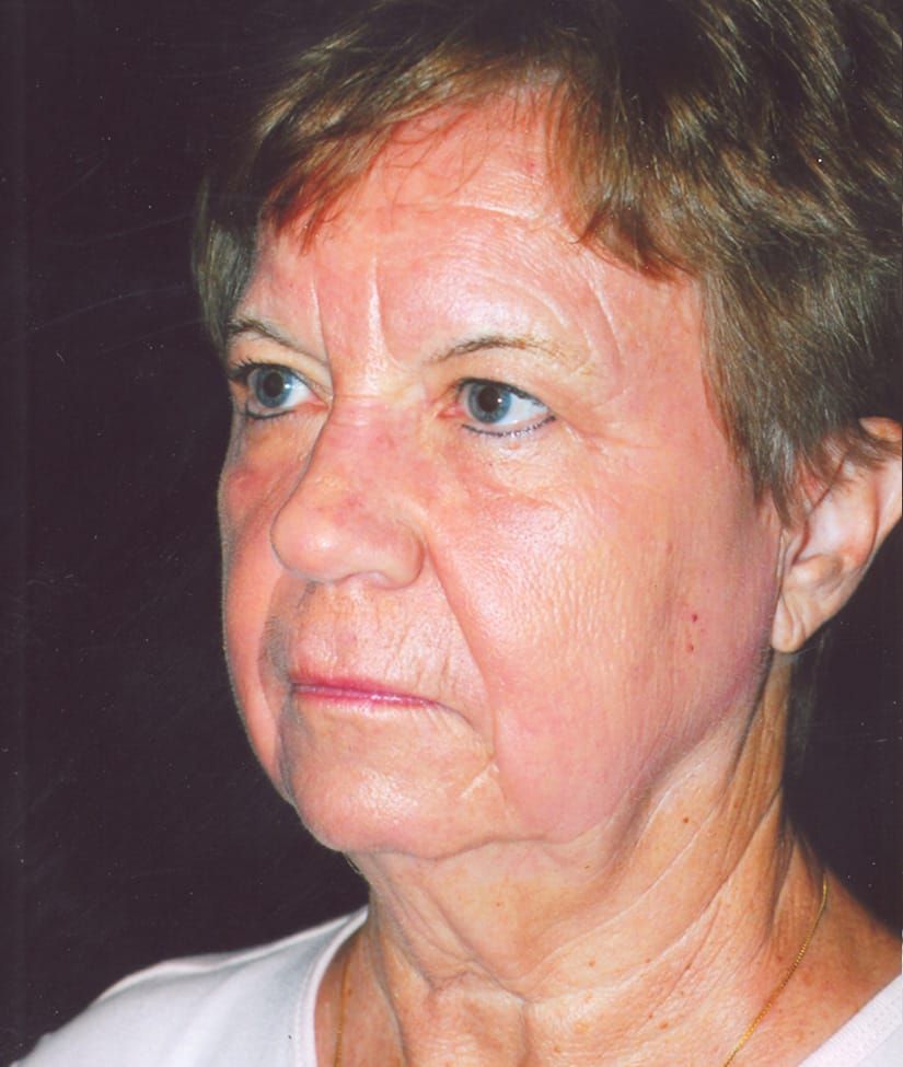 Face Resurfacing Before & After