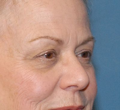 Face Resurfacing Before & After