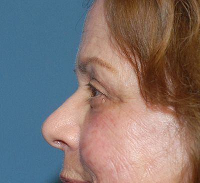 Face Resurfacing Before & After