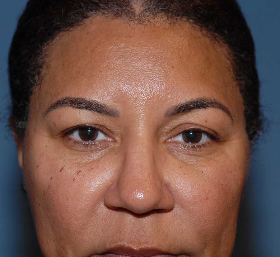 Blepharoplasty Before & After