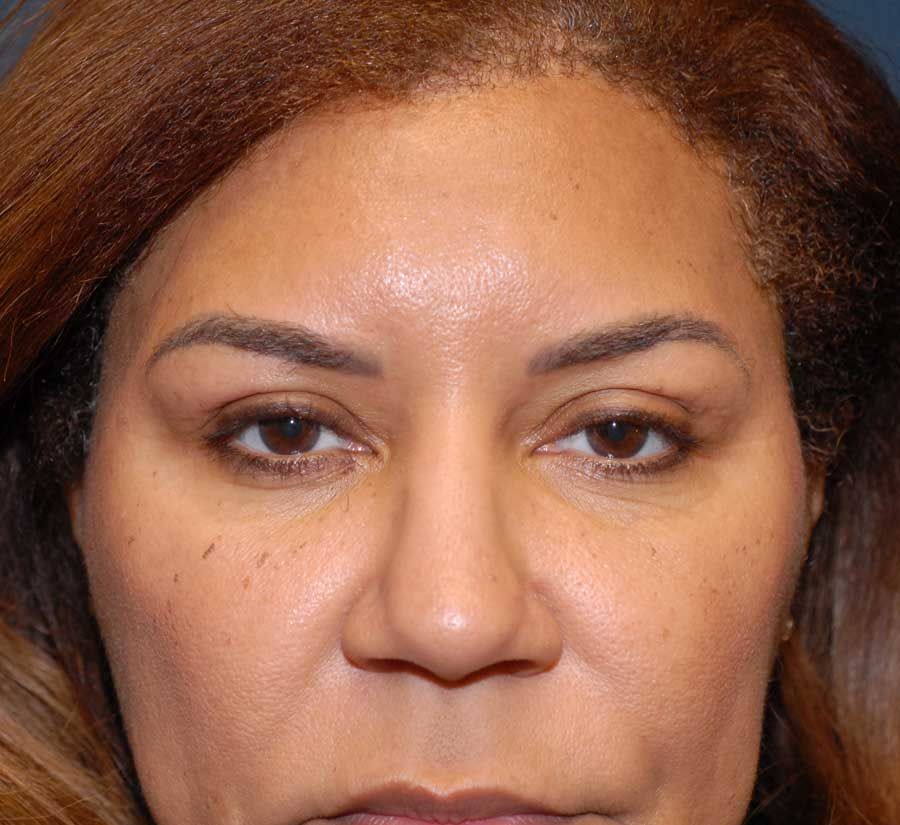 Blepharoplasty Before & After