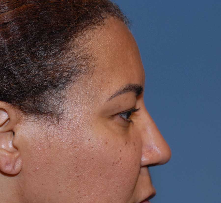 Blepharoplasty Before & After