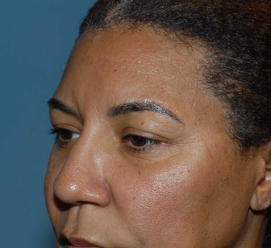 Blepharoplasty Before & After