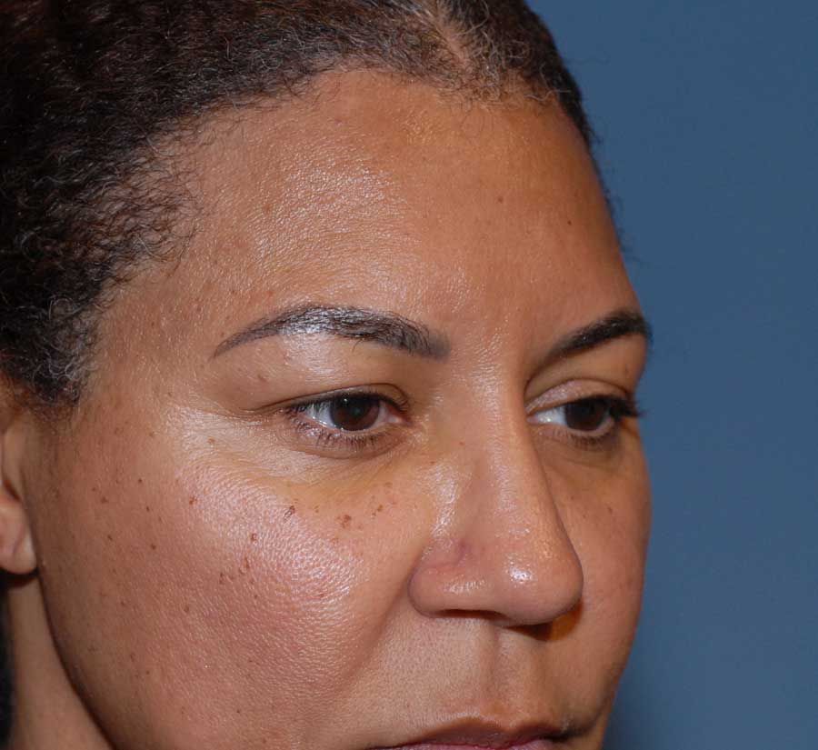 Blepharoplasty Before & After