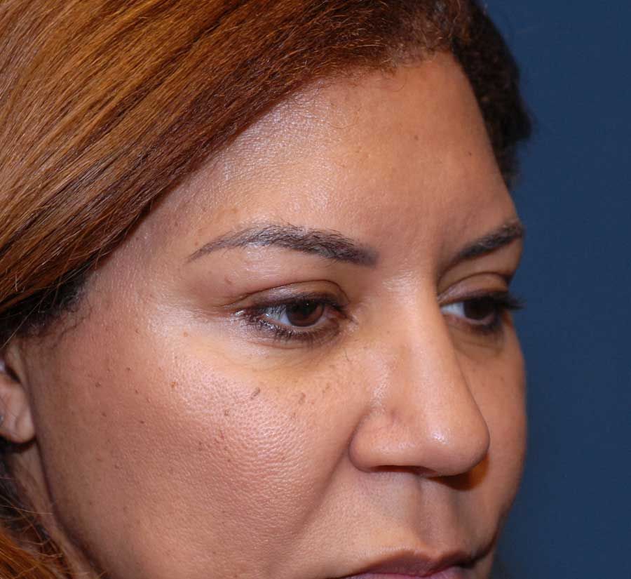 Blepharoplasty Before & After