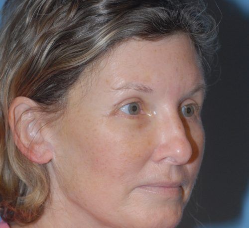 Blepharoplasty Before & After