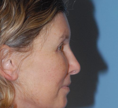 Blepharoplasty Before & After