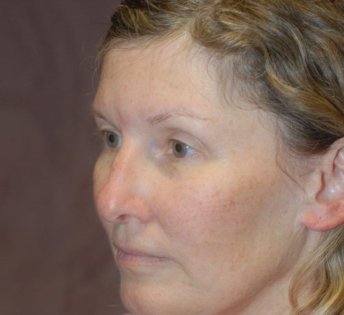 Blepharoplasty Before & After