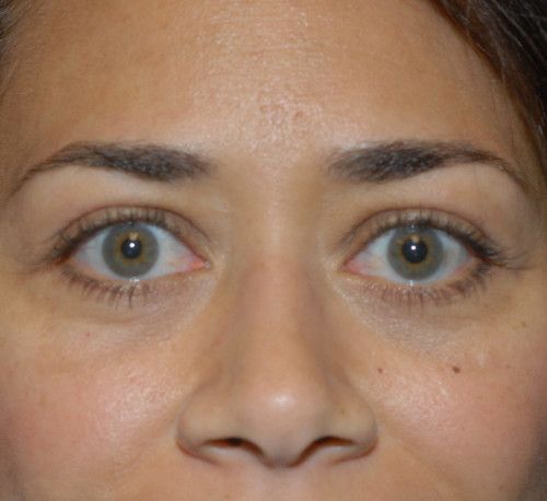 Blepharoplasty Before & After