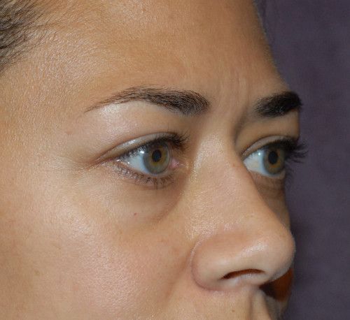 Blepharoplasty Before & After
