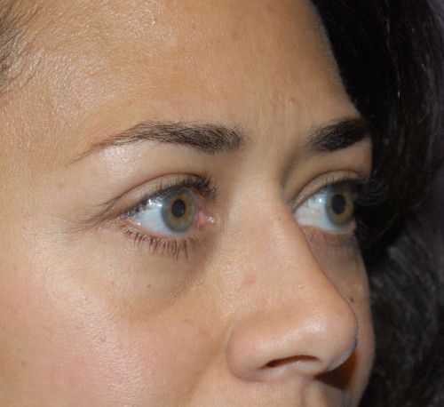 Blepharoplasty Before & After
