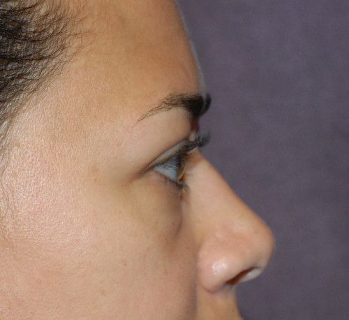 Blepharoplasty Before & After