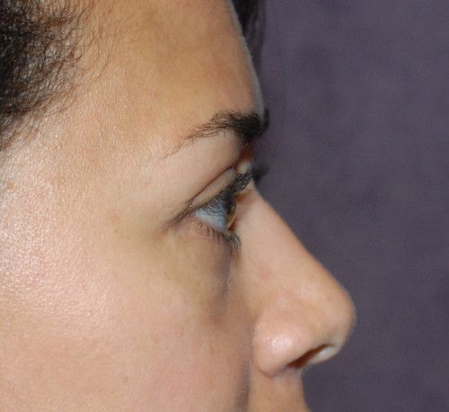 Blepharoplasty Before & After