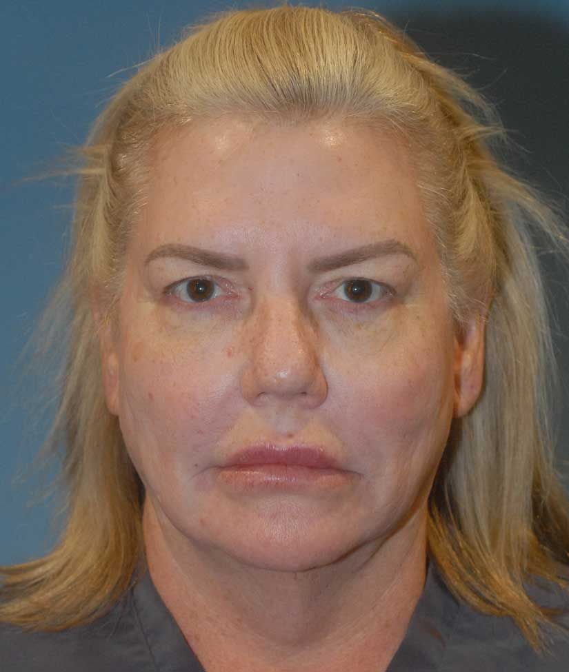 Blepharoplasty Before & After