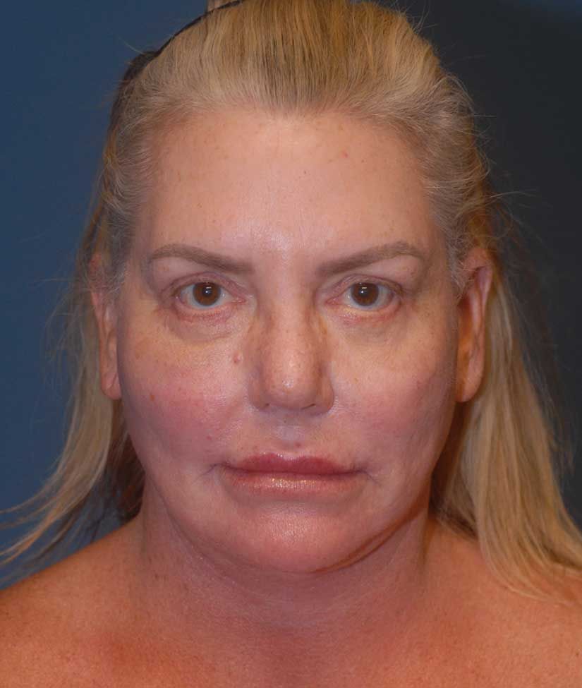 Blepharoplasty Before & After