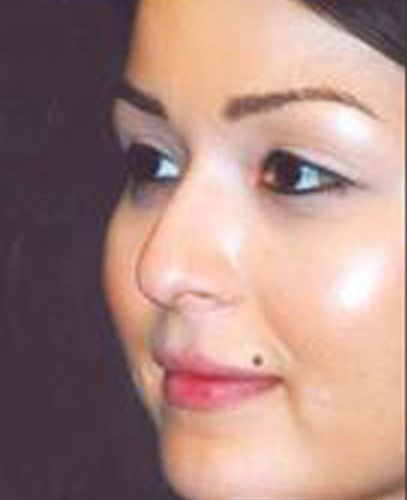 Blepharoplasty Before & After