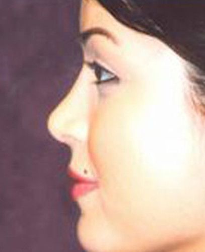 Blepharoplasty Before & After