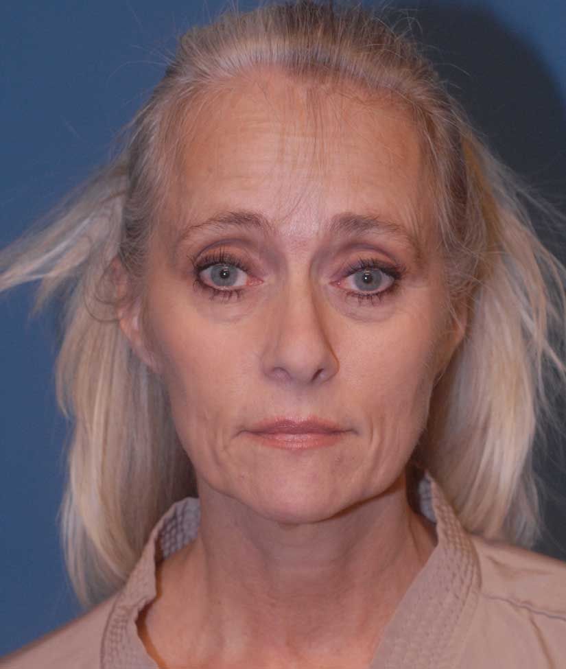 Blepharoplasty Before & After