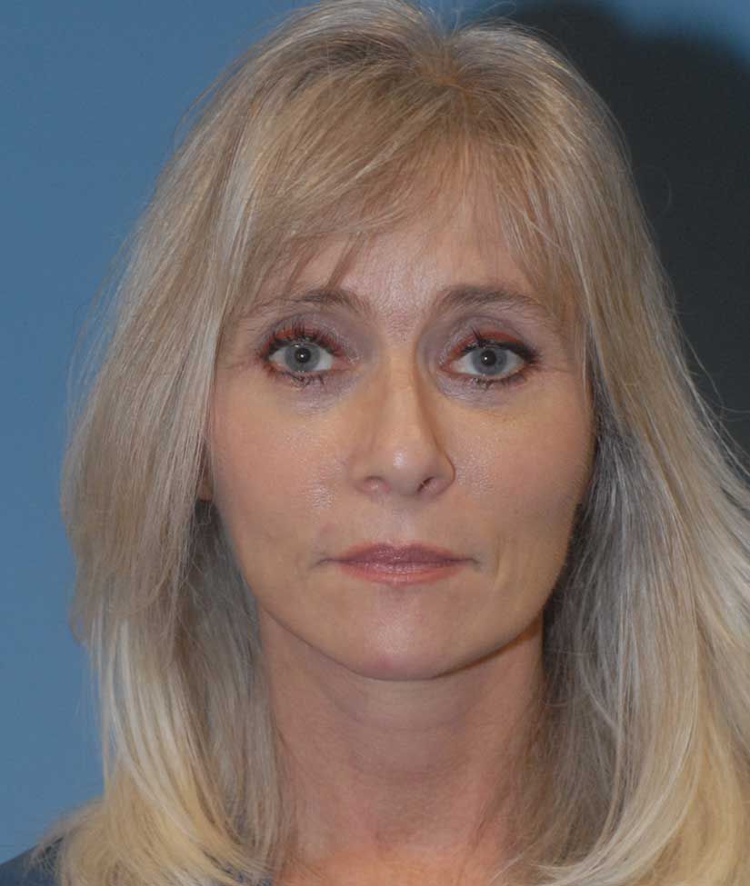 Blepharoplasty Before & After