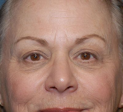 Blepharoplasty Before & After