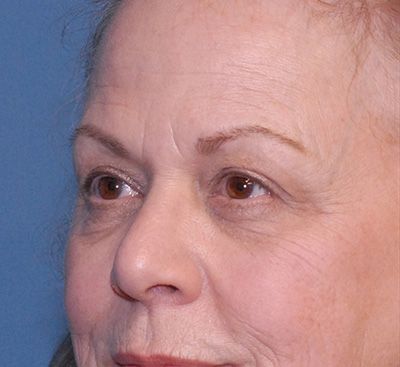 Blepharoplasty Before & After