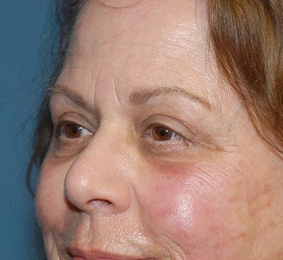 Blepharoplasty Before & After