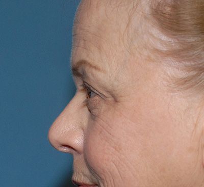 Blepharoplasty Before & After