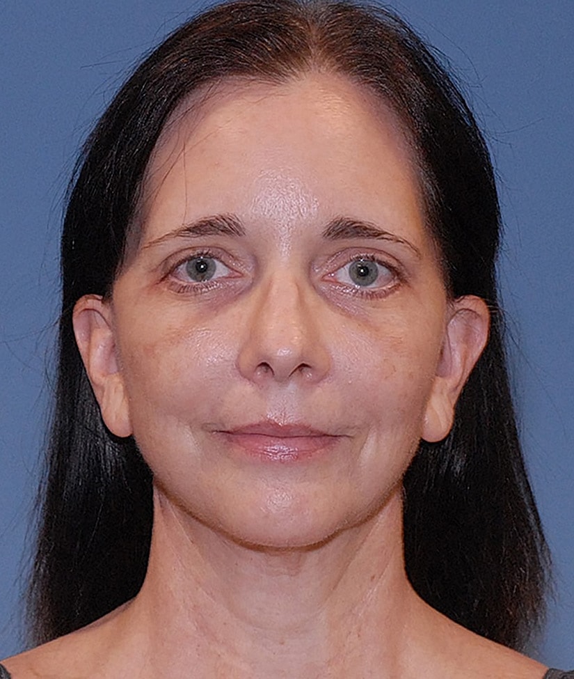 Blepharoplasty Before & After