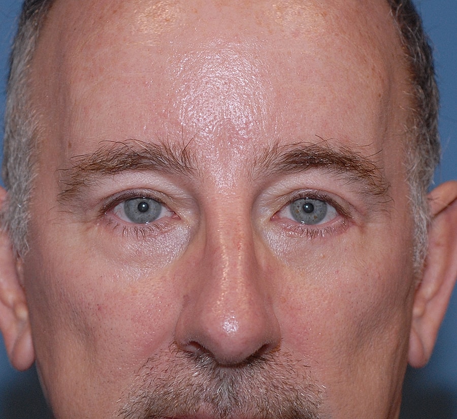 Blepharoplasty Before & After
