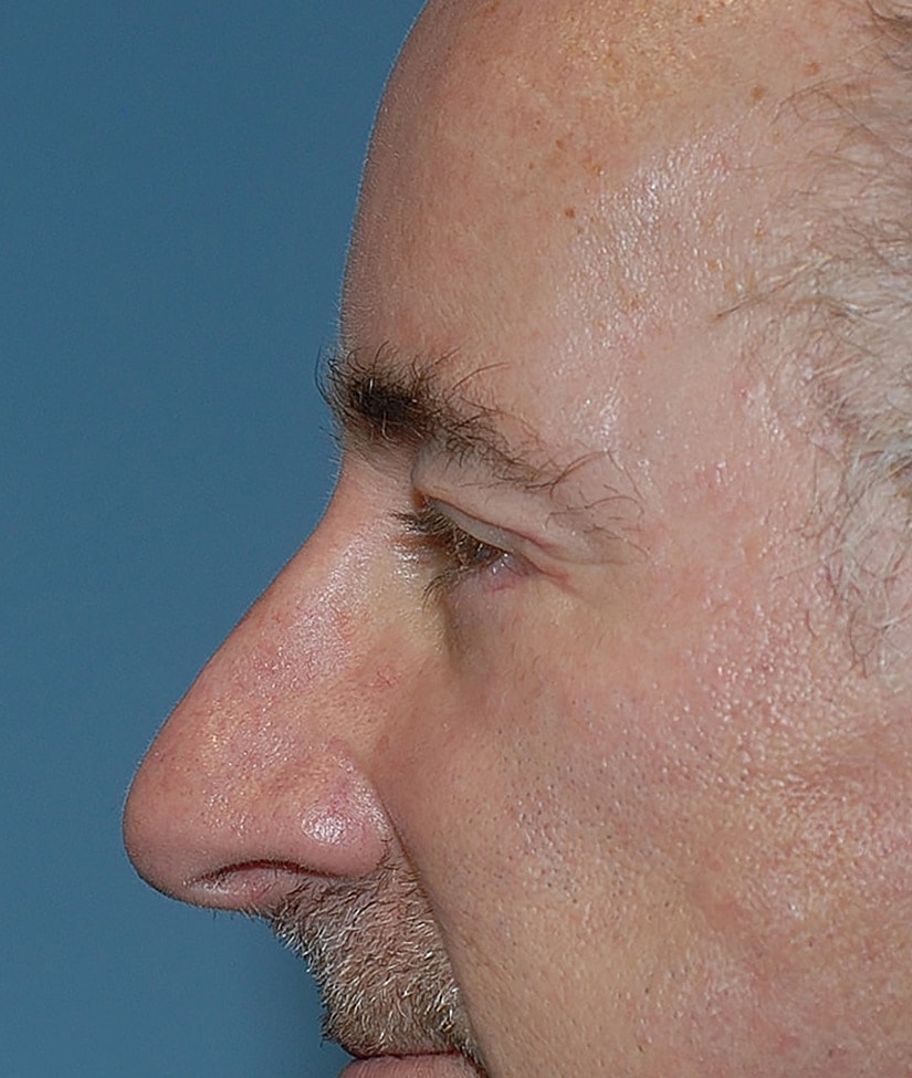 Blepharoplasty Before & After