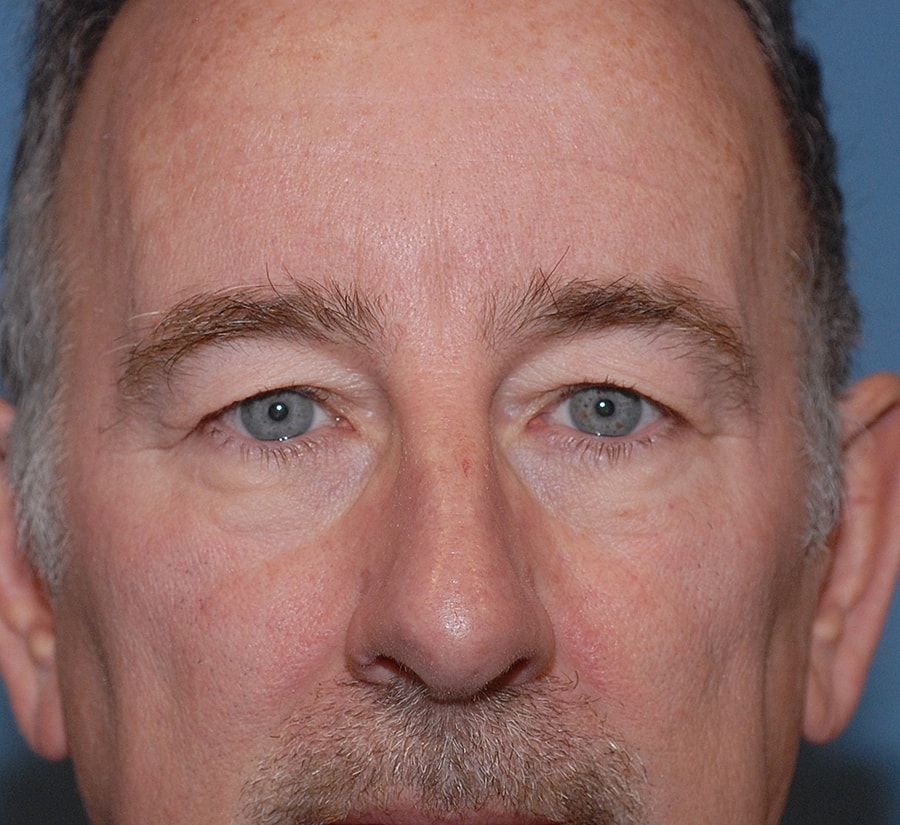 Blepharoplasty Before & After