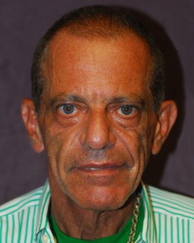 Liquid Facelift Before & After